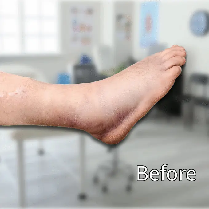 No More Swollen Feet